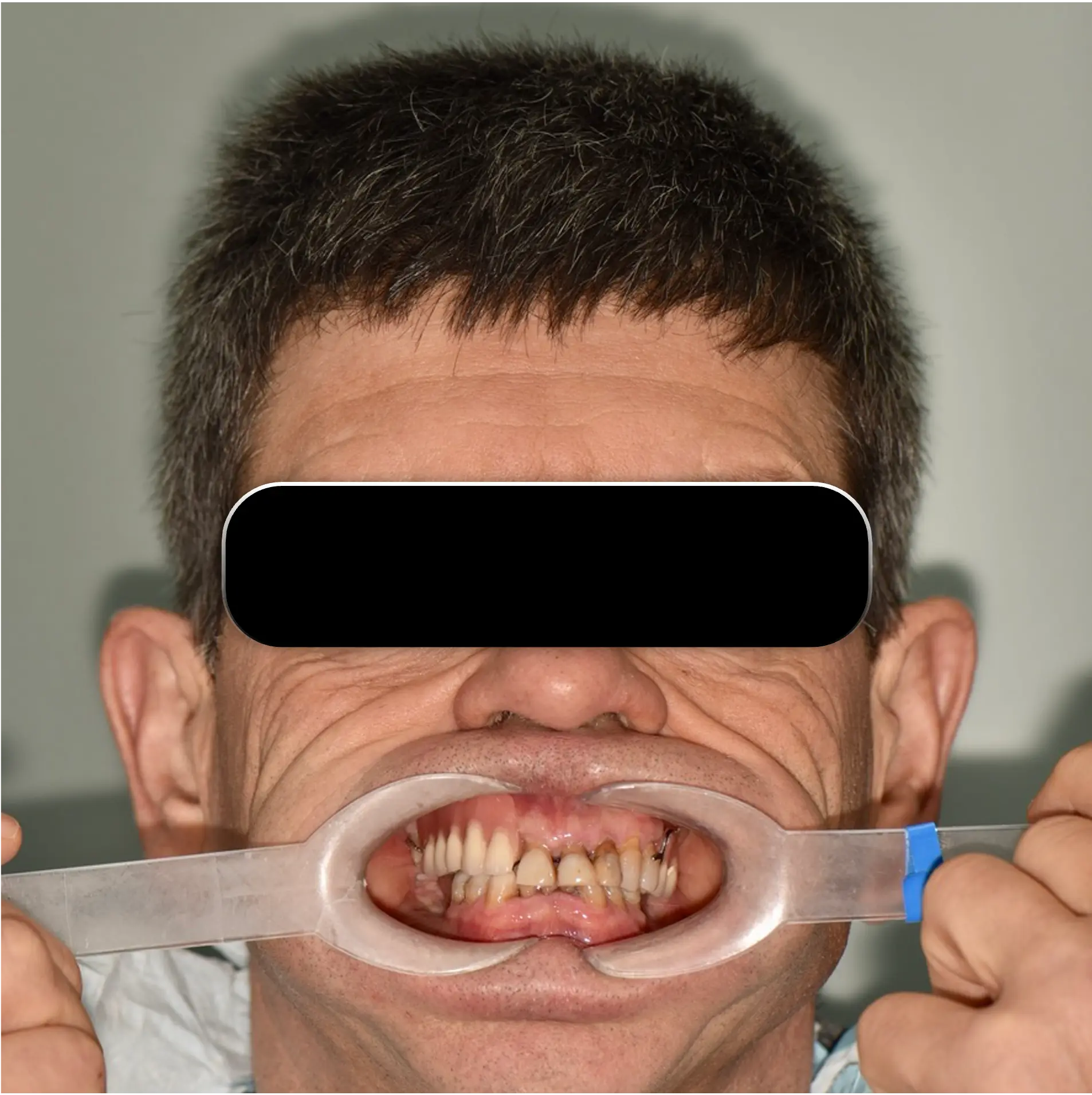 Pre-Op Step 1